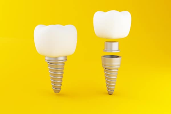 ¿Qué son los implantes dentales?