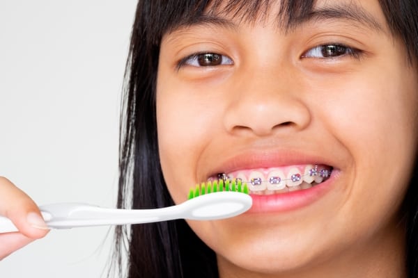 ¿Cómo cuidar tus dientes con brackets?