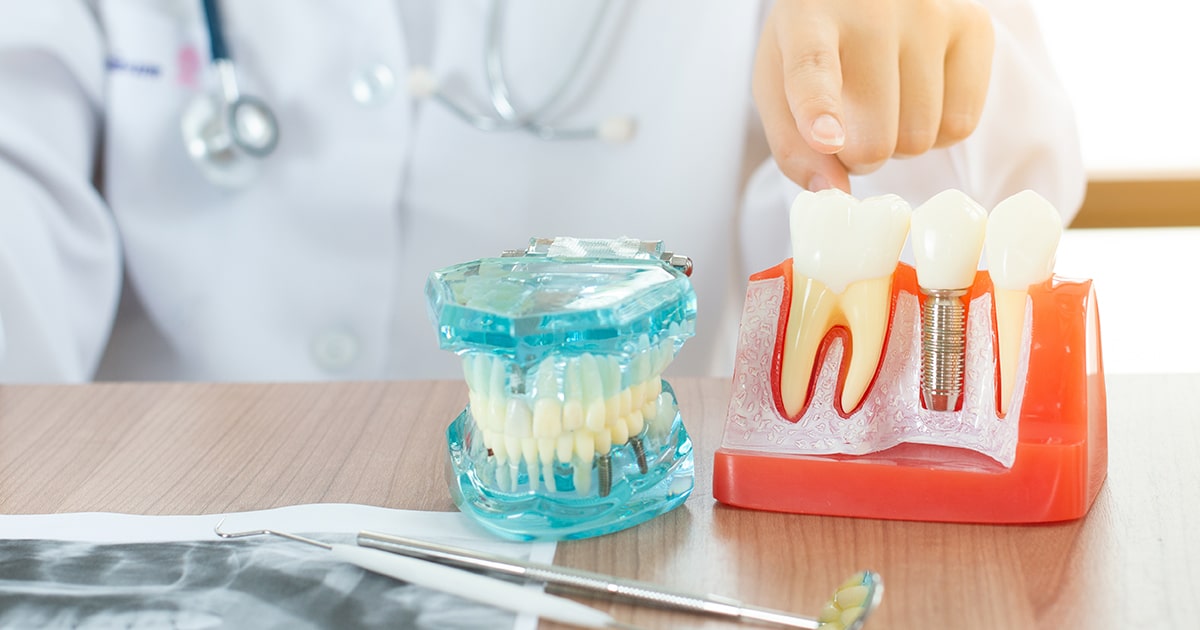 Implantes dentales de calidad en Sevilla