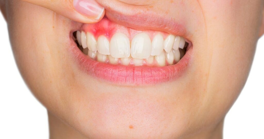 La periodontitis tiene solución