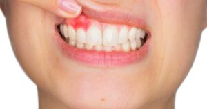 La periodontitis tiene solución